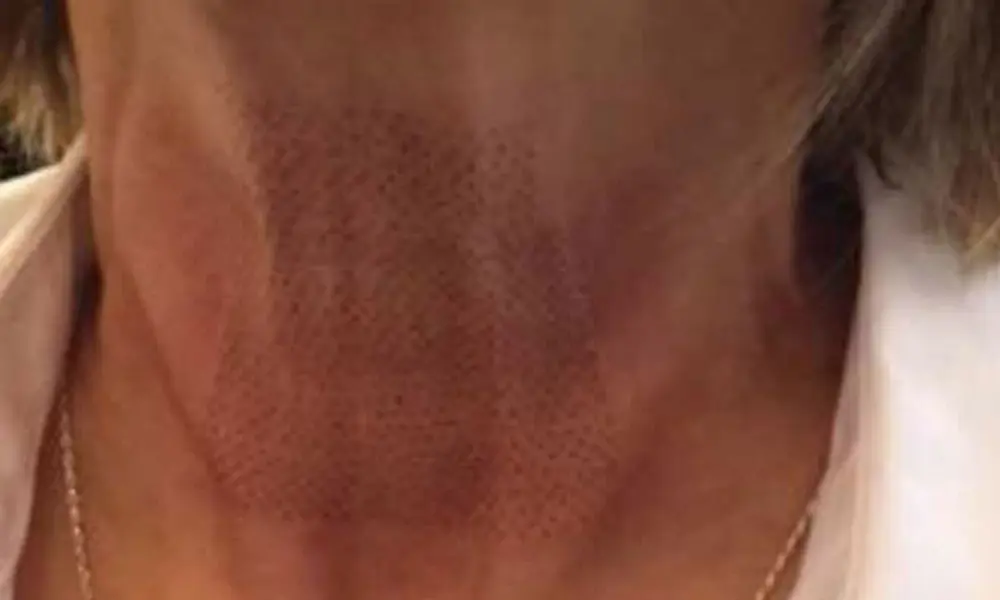 Before & After Treatment after image