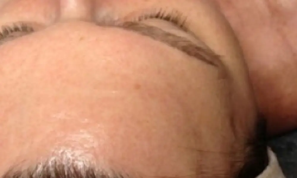 Before & After Treatment after image