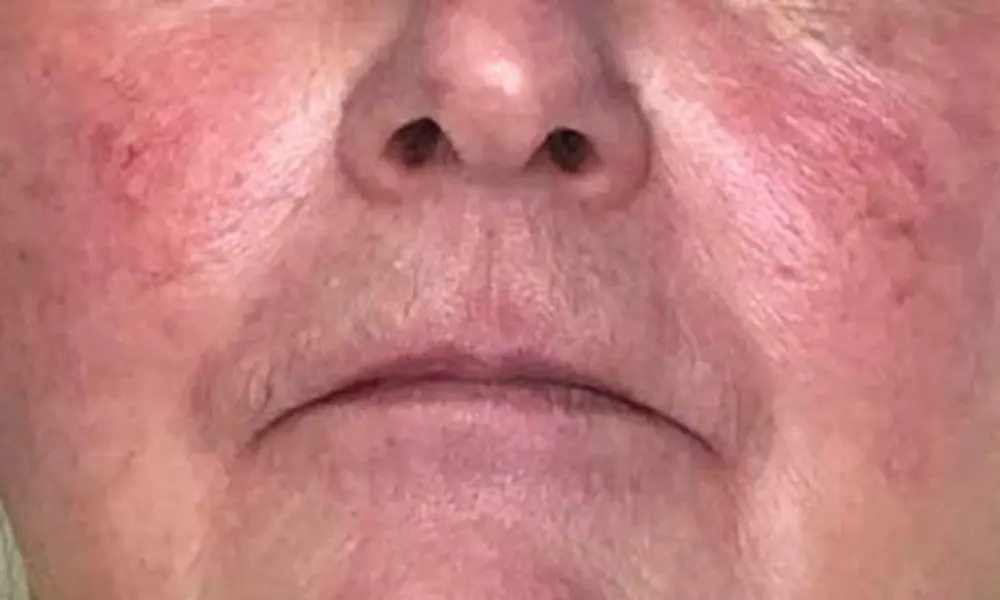 Before & After Treatment after image