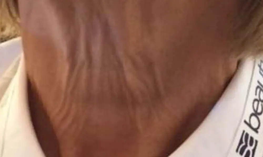 Before & After Treatment before image