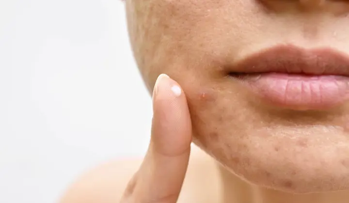 Hormonal Acne Treatments