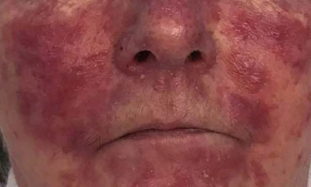 Before & After Treatment before image