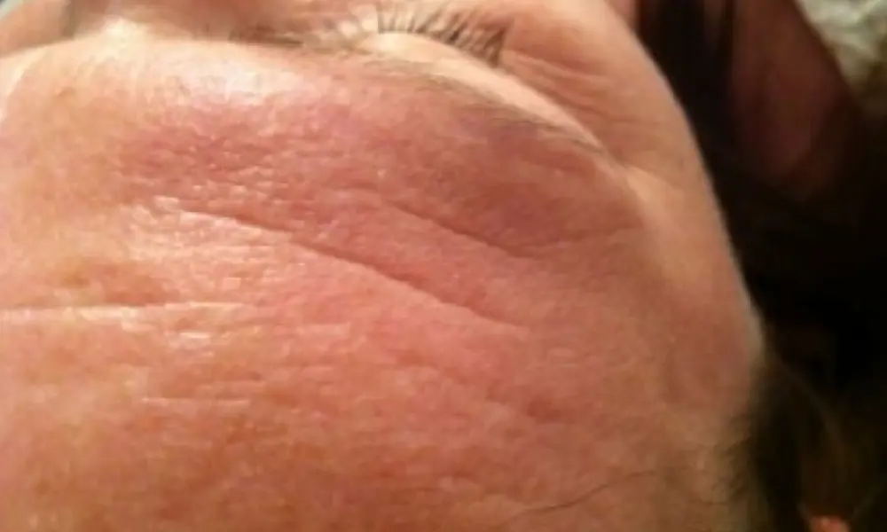 Before & After Treatment before image
